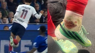 ¡Vea cómo le quedó el tobillo a jugador tras falta de Jeyland Mitchell!
