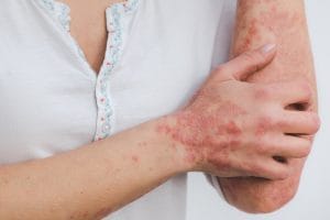La artritis psoriásica aparece aproximadamente en un 30% de los pacientes con psoriasis