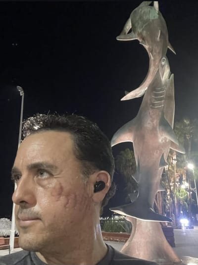 Mauricio Hoyos enseña la cicatriz tras el ataque de tiburón en la Isla del Coco. Foto: Mauricio Hoyos