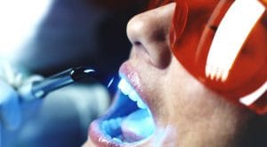 blanqueamiento dental