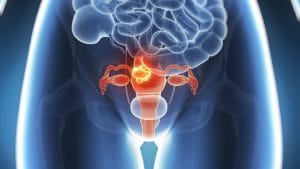 Por lo menos dos cepas del Virus Papiloma, están directamente relacionados al cáncer de cérvix