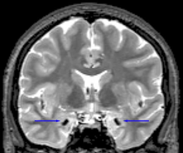 Resonancia magnética de una persona con enfermedad de Urbach-Wiethe. Las flechas indican calcificación bilateral en la amígdala basolateral, una región del cerebro implicada en el aprendizaje del miedo y la toma de decisiones sociales. Foto: David Terburg.